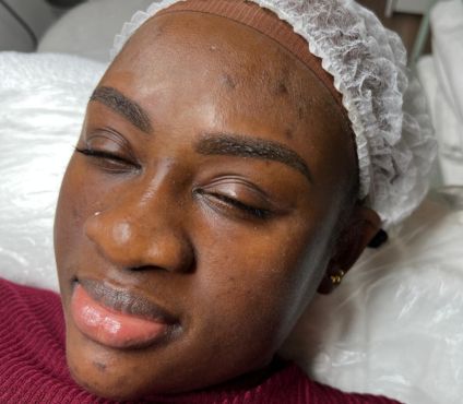 Full Face Natural Results 9